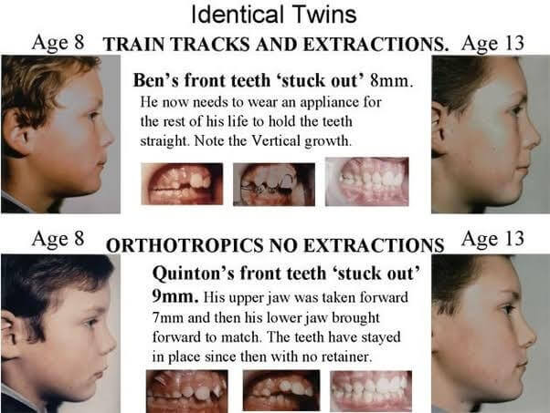 Eric Davis Dental - Overbite: Understanding the Overbite and How