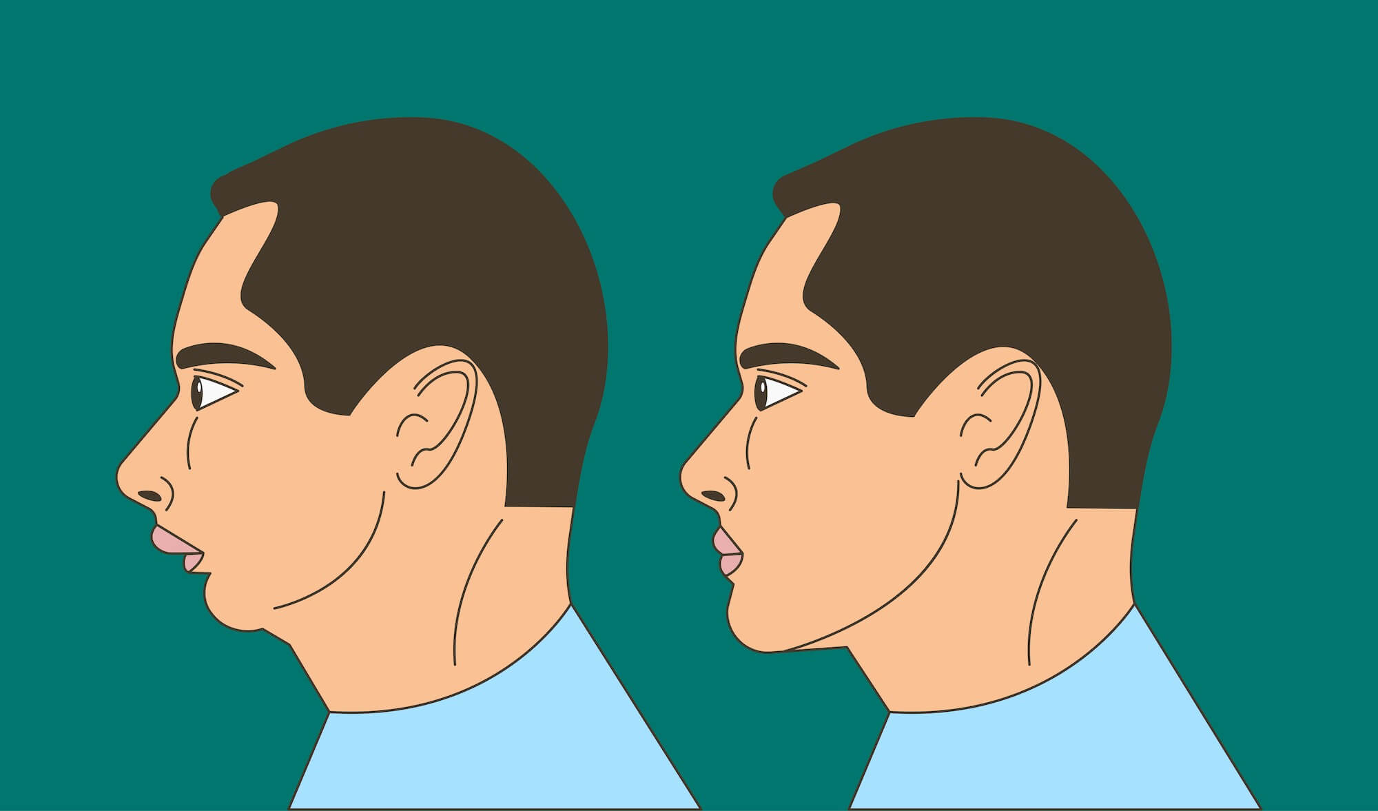 Mewing and Orthotropics: How to Change Your Facial Bone Structure