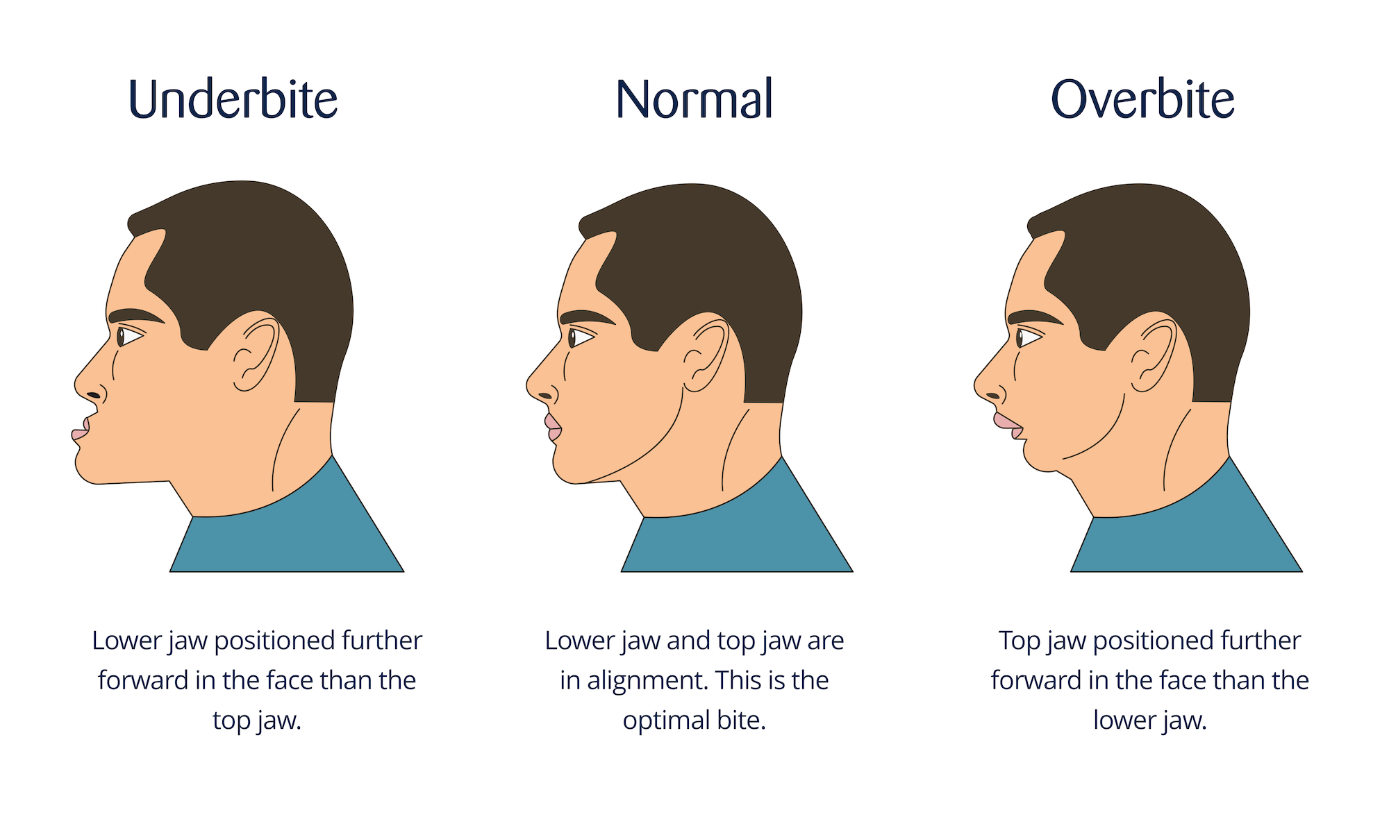 Eric Davis Dental Underbite What Causes It And How To Fix It